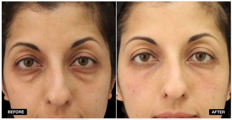 Under Eye Filler Before and After Results