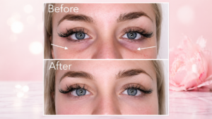 Under Eye Filler Before and After 2026