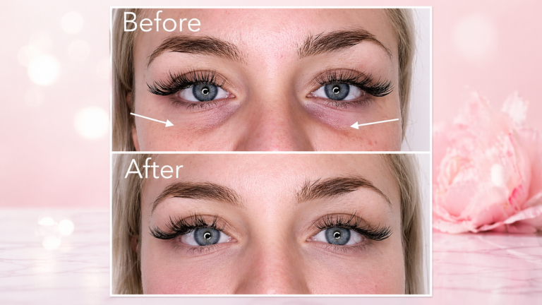 Under Eye Filler Before and After 2026