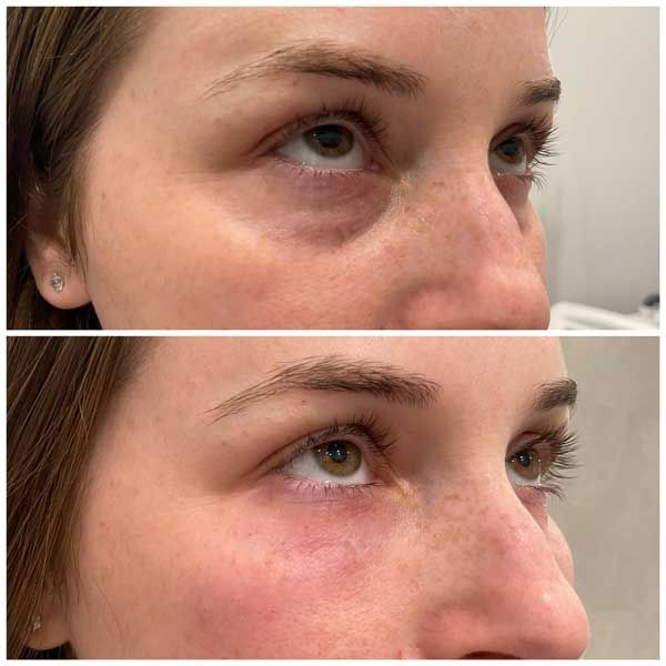 First 24 Hours Under Eye Filler