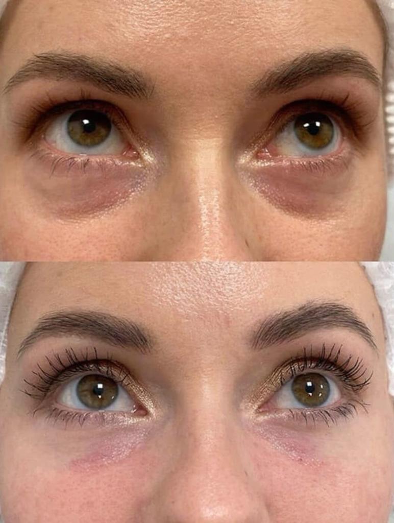 Lower Eyelid-to-Cheek Transition