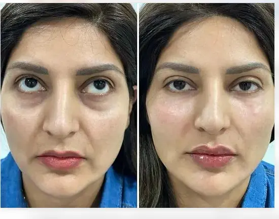 softer under-eye hollows