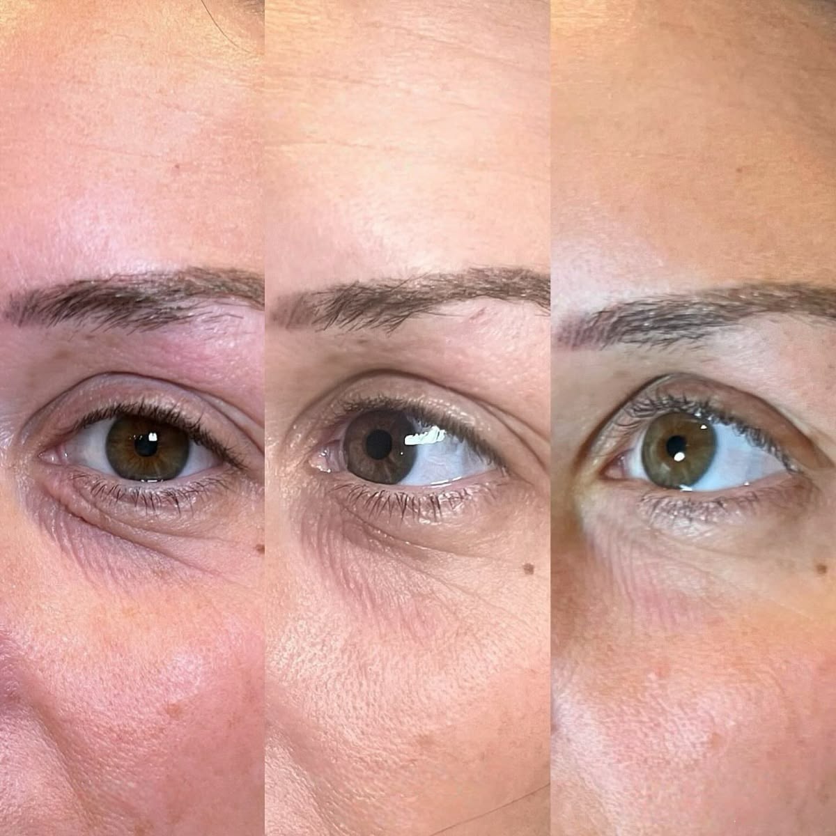 Dent Under Eye After Filler