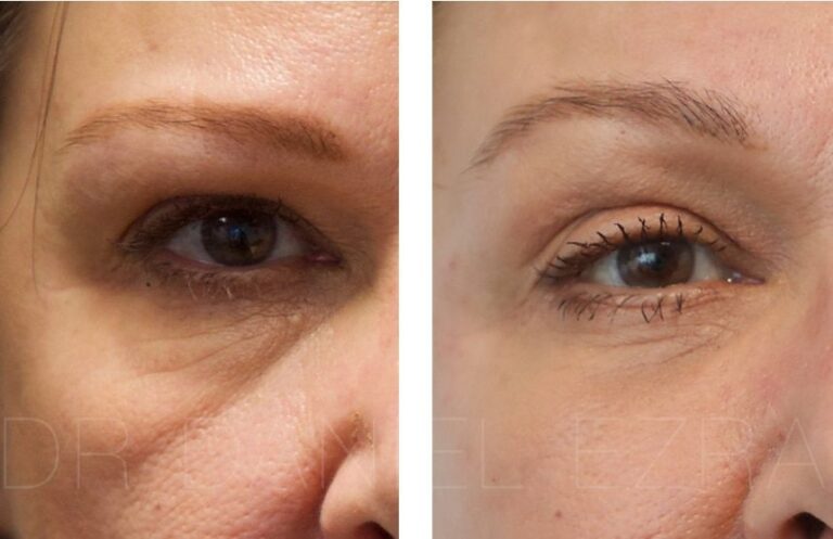 Under Eye Filler for Wrinkles