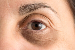 Under Eye Fillers for Dark Circles