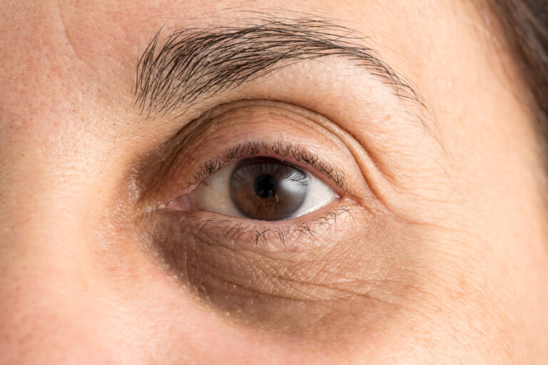 Under Eye Fillers for Dark Circles