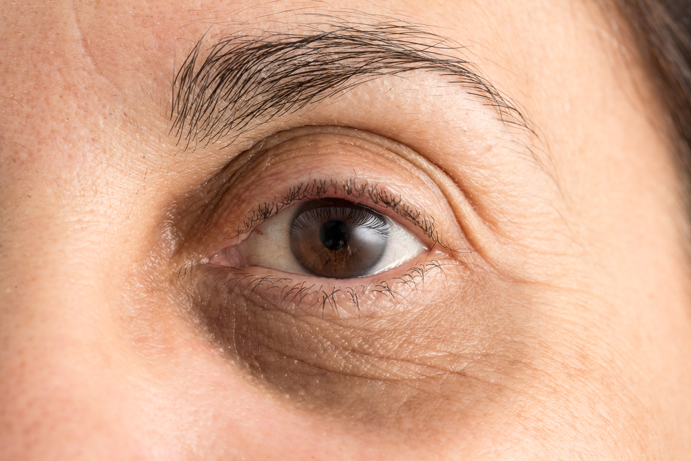 Under Eye Fillers for Dark Circles