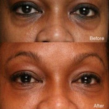 Under Eye Filler for Dark Circles and Wrinkles
