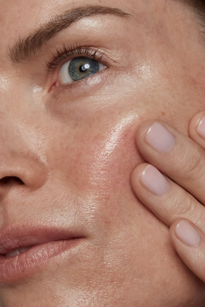 under eye filler swelling stages week 2-4
