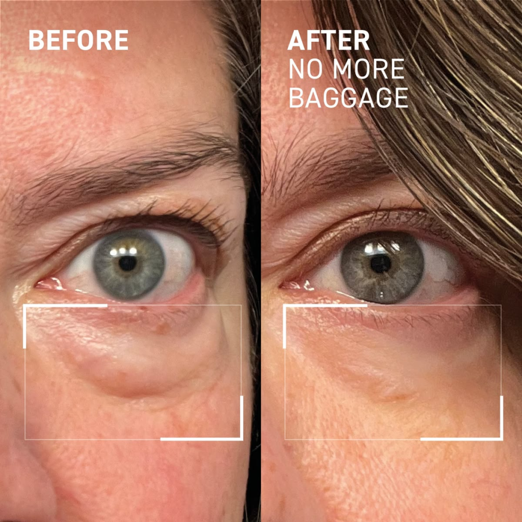 Botox for Wrinkles