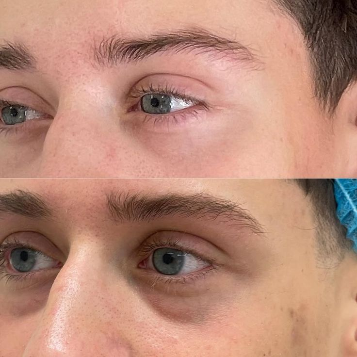Asymmetric Swelling Creating a False Valley