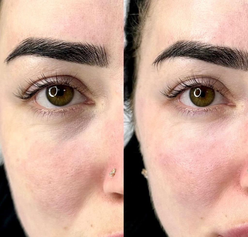HA Filler Under Eyes