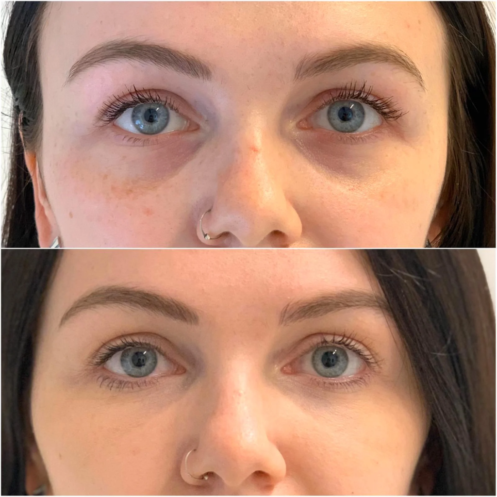 Fix Dent Under Eyes Filler