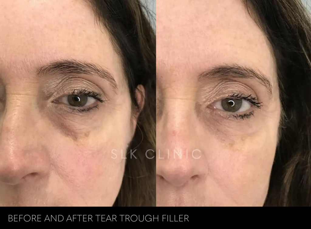 Recovery Under Eye Filler Before and After