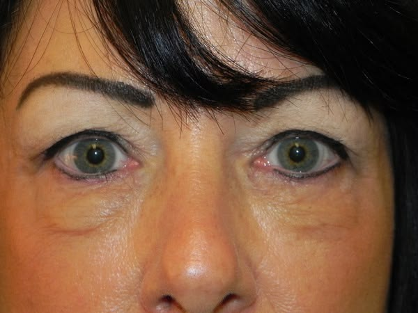 under eye filler swelling stages from day 0 to 1