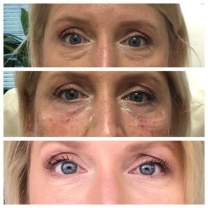 under eye filler swelling stages