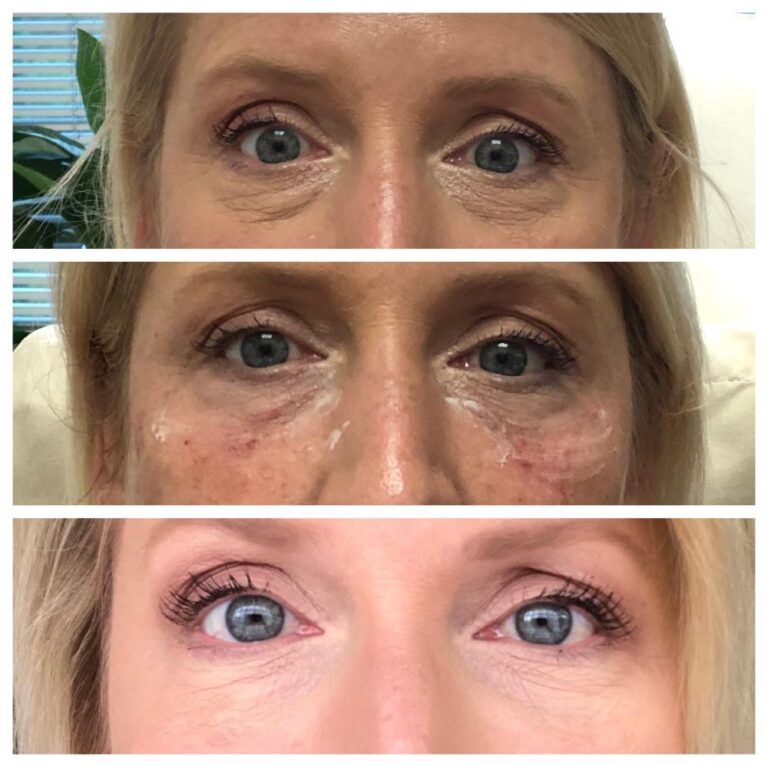 under eye filler swelling stages