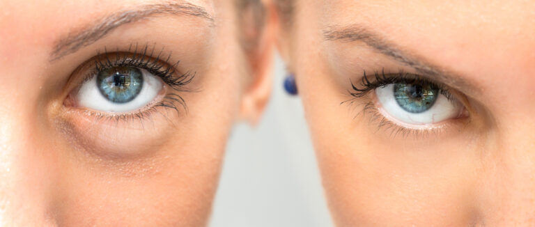 Filler For Under Eye Bags Before And After 2026