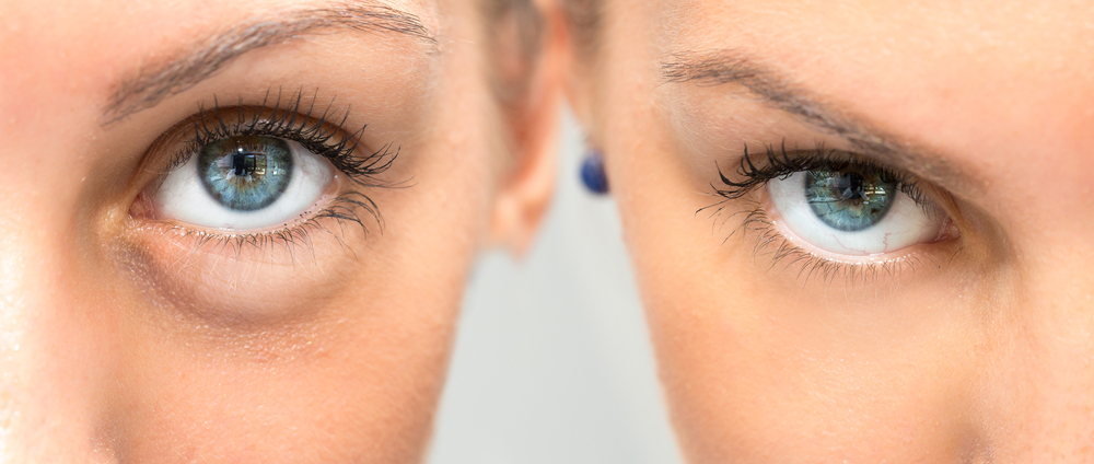 Filler For Under Eye Bags Before And After 2026
