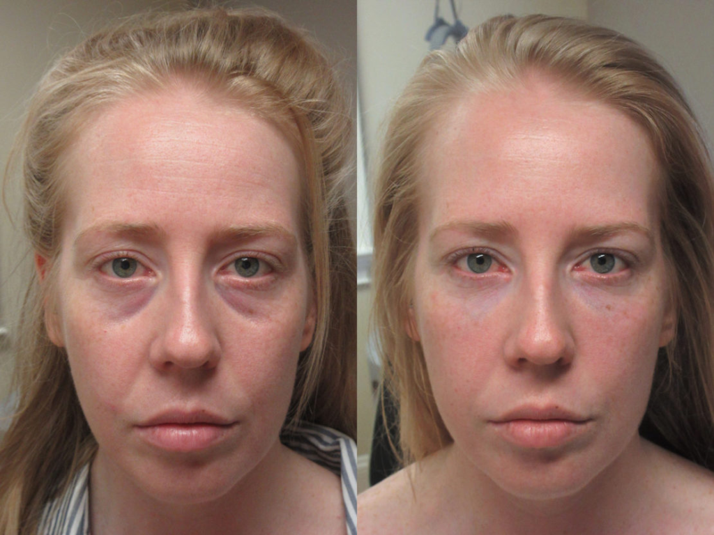 Bags, Hollows, and Dark Circles Are Not the Same Thing