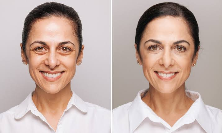 How Results Look When You Smile or Move Your Face