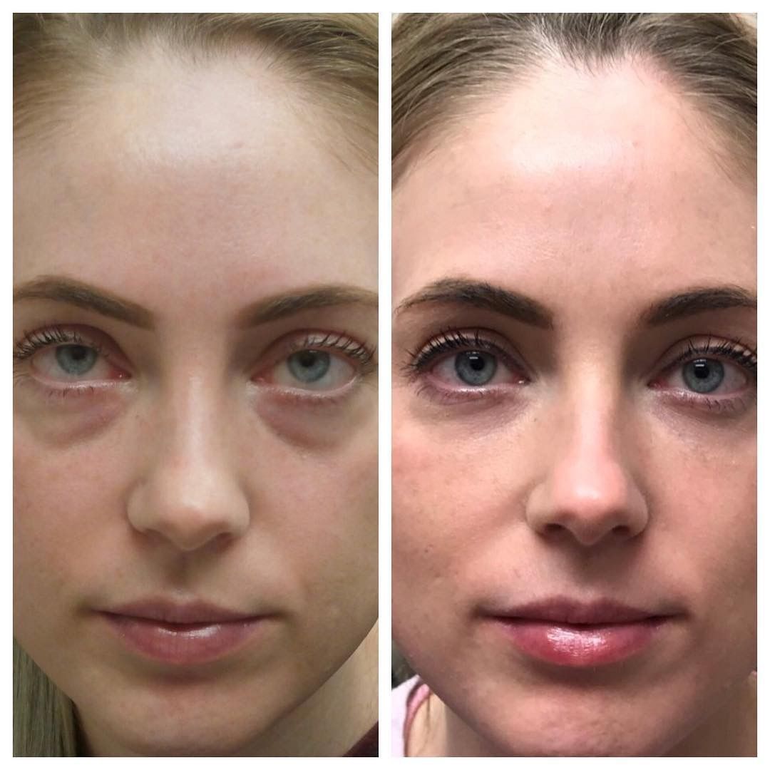 Under Eye Filler Bruising