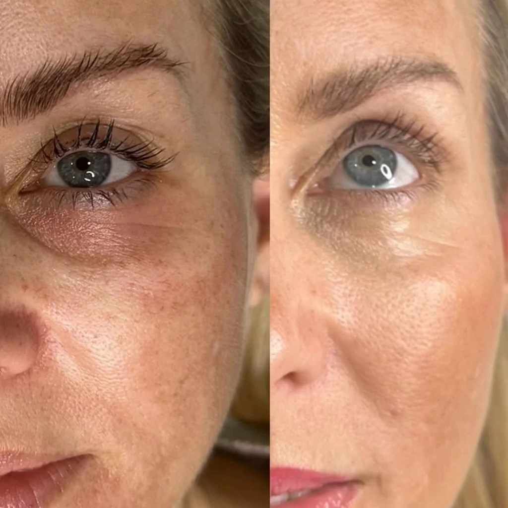 Under-Eye Area Bruises